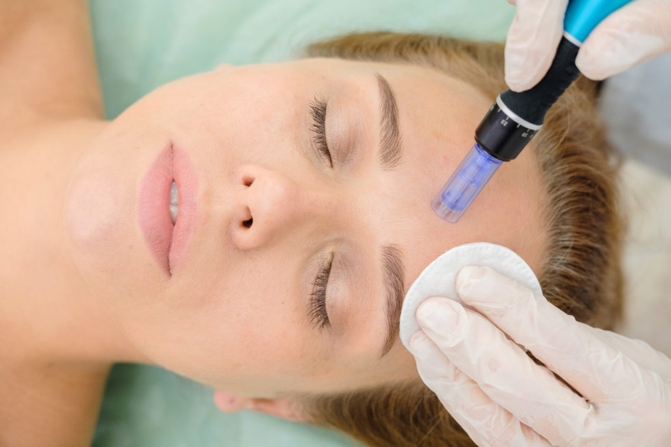 Microneedling – Όσα πρέπει να γνωρίζετε