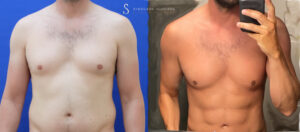 VASER 4D λιποαναρρόφηση