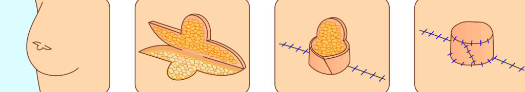 Αποκατάσταση θηλής/ Άλου