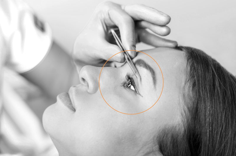 Βλεφαροπλαστική