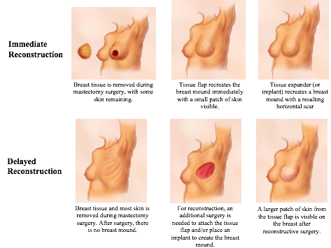 Αποκατάσταση μαστού