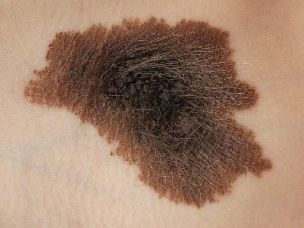 Συγγενείς Μελανοκυτταρικοί Σπίλοι