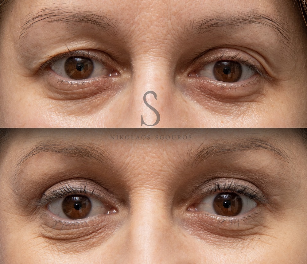 Βλεφαροπλαστική2