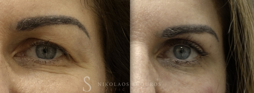 Βλεφαροπλαστική 1