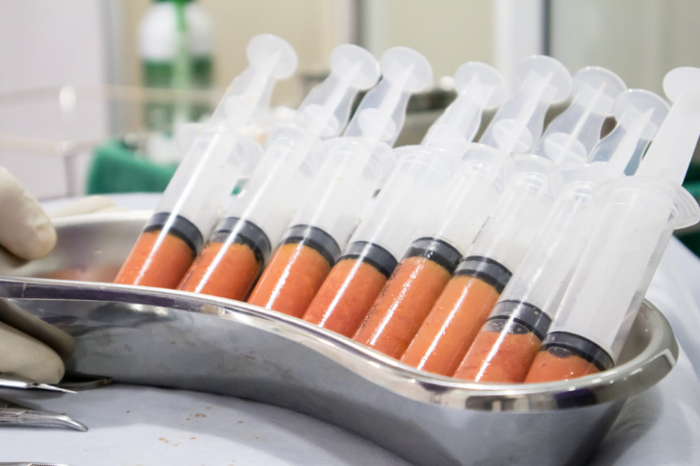 Τρεις λόγοι που κάνουν τη λιπομεταφορά ιδανική για εσάς