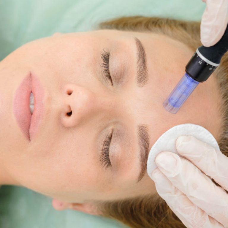 Microneedling – Όσα πρέπει να γνωρίζετε