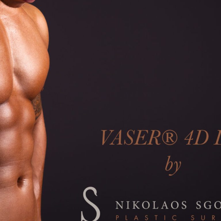 VASER 4D λιποαναρρόφηση