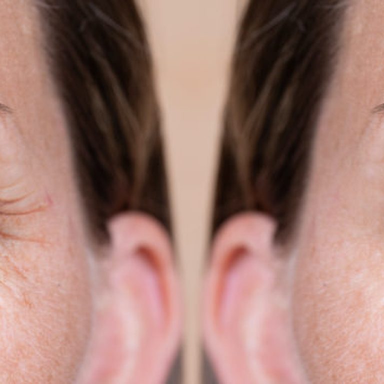 Βλεφαροπλαστική ή Plexr;