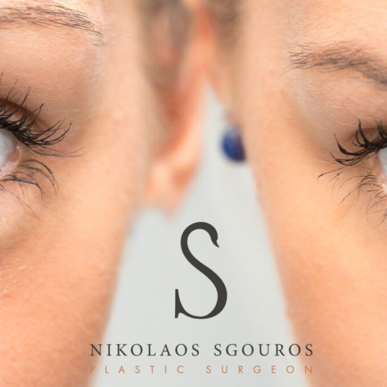 Βλεφαροπλαστική κάτω βλεφάρου μέσω του επιπεφυκότα