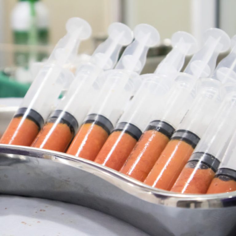 Τρεις λόγοι που κάνουν τη λιπομεταφορά ιδανική για εσάς